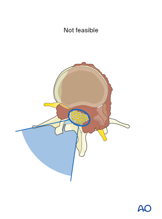 Primary lumbar tumor not feasible for en bloc resection with posterior release and anterior tumor delivery