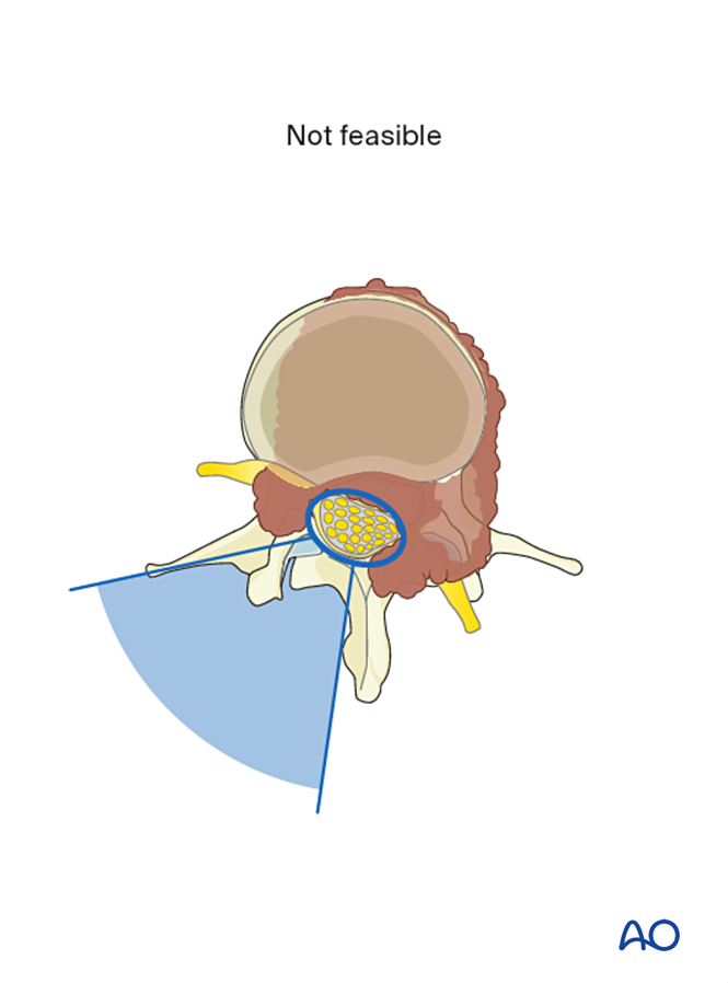 En bloc resection with posterior release and anterior tumor delivery ...