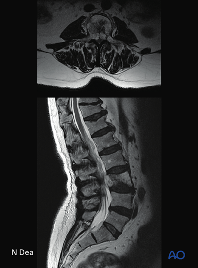 En bloc resection with posterior release and anterior tumor delivery ...