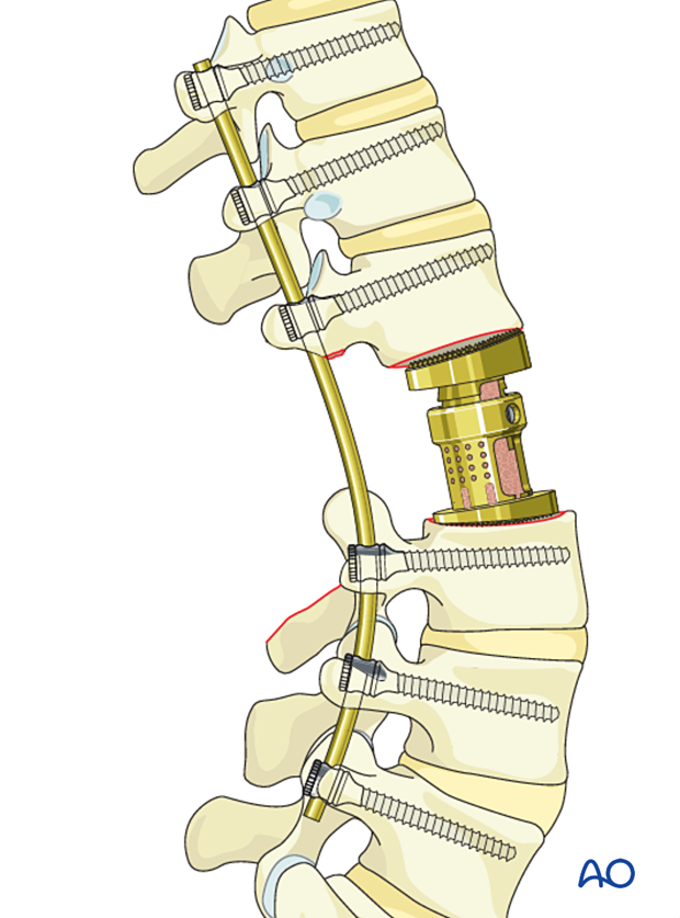 Reconstruction strategy of en bloc resection with posterior release and anterior delivery of a primary lumbar tumor