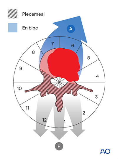 En bloc resection with posterior release and anterior tumor delivery ...