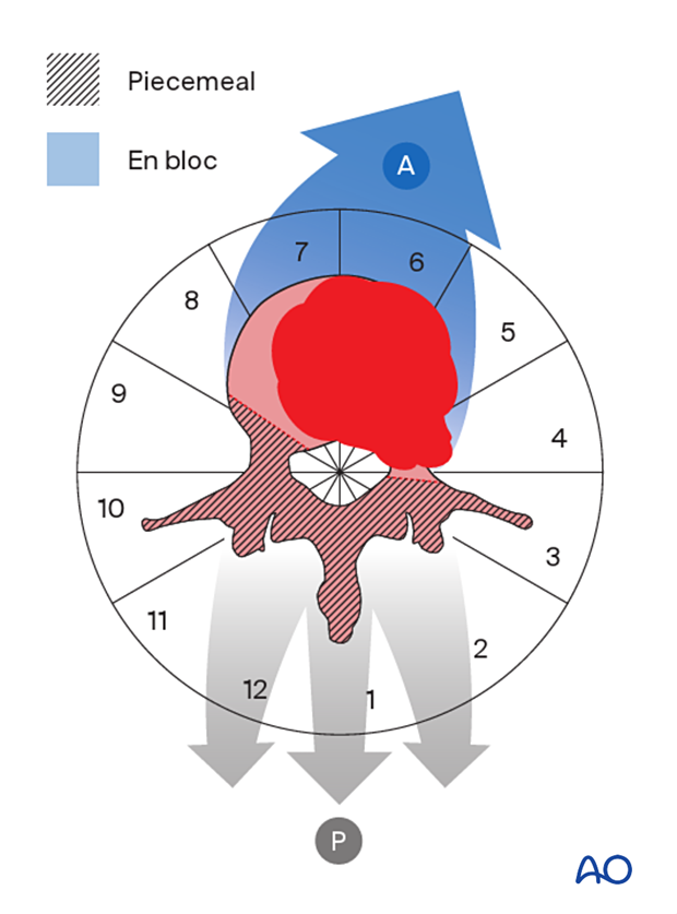 Strategy of en bloc resection with posterior release and anterior delivery of a primary lumbar tumor
