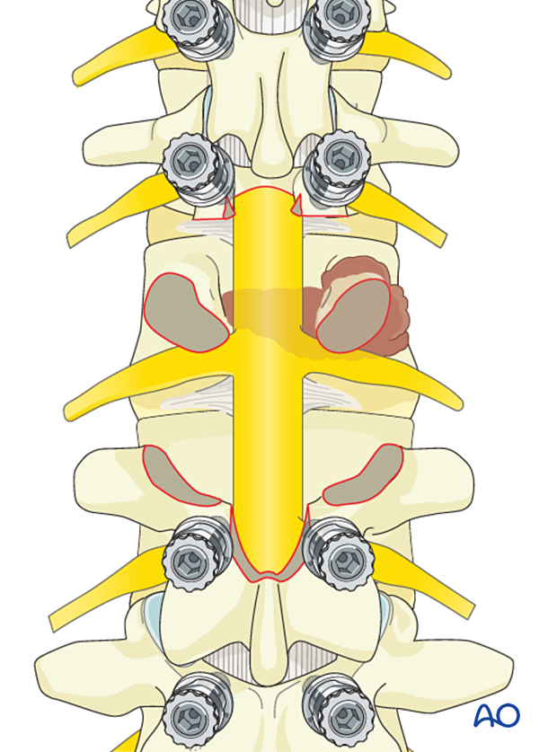 Isolation and dissection of L2 nerve roots during en bloc resection with posterior release and anterior delivery of a primary L2 tumor