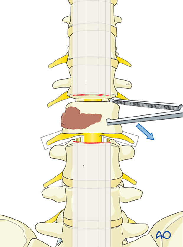 Anterior delivery of a primary lumbar tumor