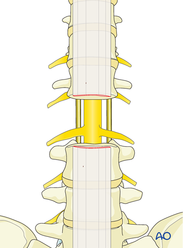 Anterior view of the spine with the L2 body and primary tumor removed and posterior rod stabilization