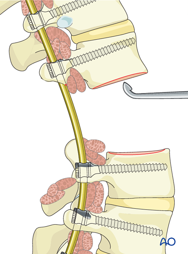 Preparation of endplates for anterior reconstruction during en bloc resection with posterior release and anterior delivery of a primary lumbar tumor