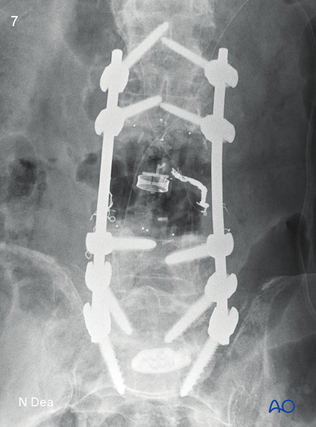 Intraoperative AP image after en bloc resection with posterior release and anterior delivery of a primary lumbar tumor showing position of screws, rods, and expandable prosthesis 