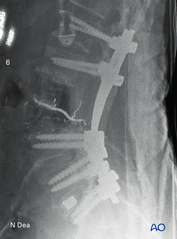 Intraoperative imaging (lateral view) after en bloc resection with posterior release and anterior delivery of a primary lumbar tumor showing position of screws, rods, and expandable prosthesis