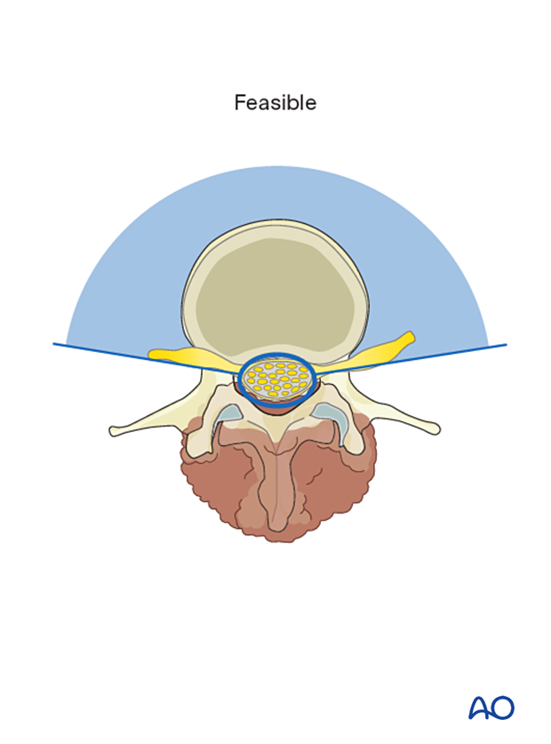 Feasible en bloc resection of a posterior lumbar tumor