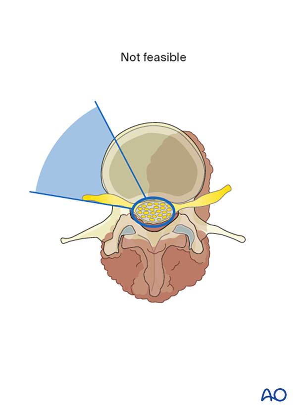 En bloc resection of posterior lumbar tumor is not feasible