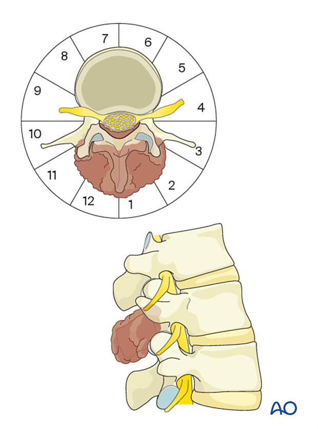 Case-based scenario for en bloc resection of posterior lumbar tumor