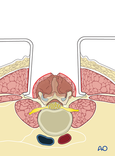 En bloc resection of a posterior tumor (L1 to L5) for Malignant lumbar ...
