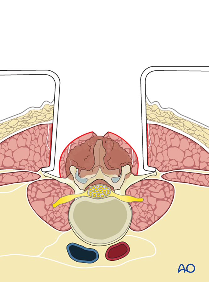 En bloc resection of a posterior tumor (L1 to L5) for Malignant lumbar ...