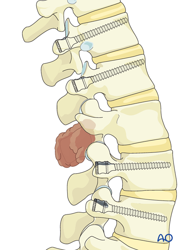 Screw insertion during en bloc resection of posterior lumbar tumor