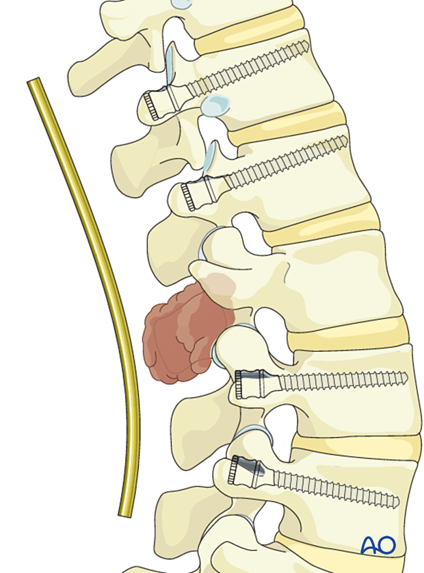 Rod preparation during en bloc resection of posterior lumbar tumor