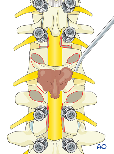 En bloc resection of a posterior tumor (L1 to L5) for Malignant lumbar ...