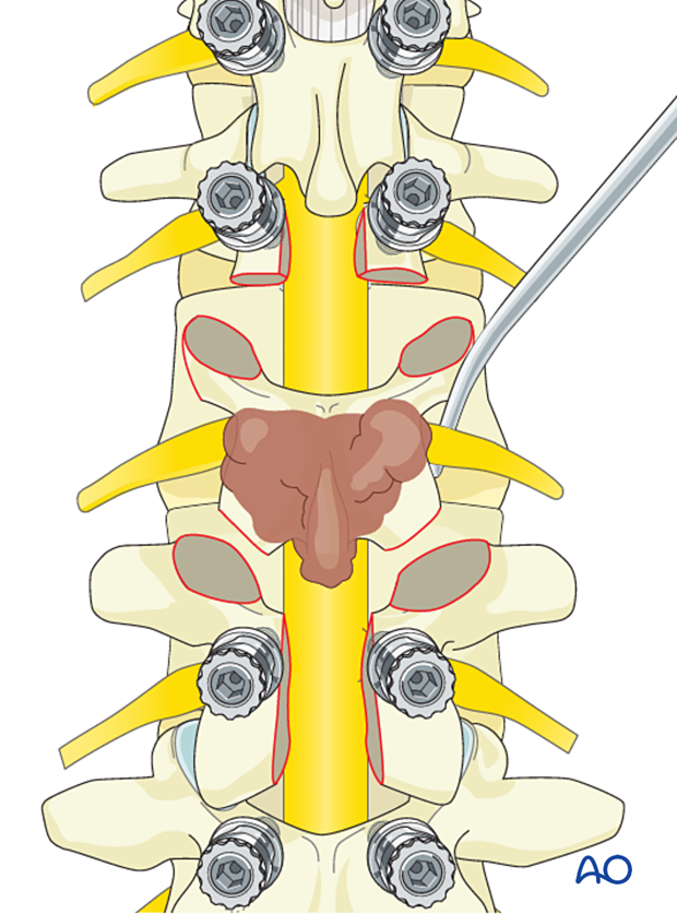 Isolation of nerve roots during en bloc resection of posterior lumbar tumor
