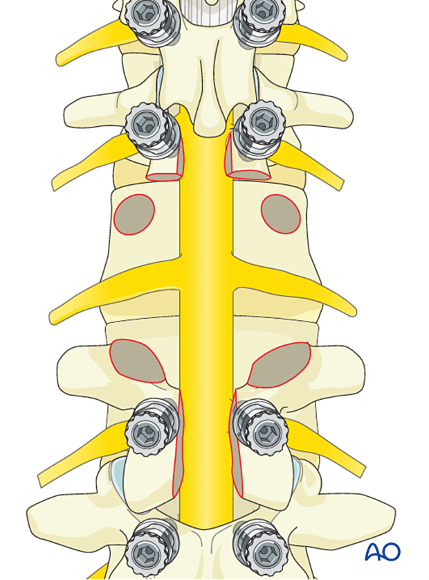 Delivery of tumor during en bloc resection of posterior lumbar tumor