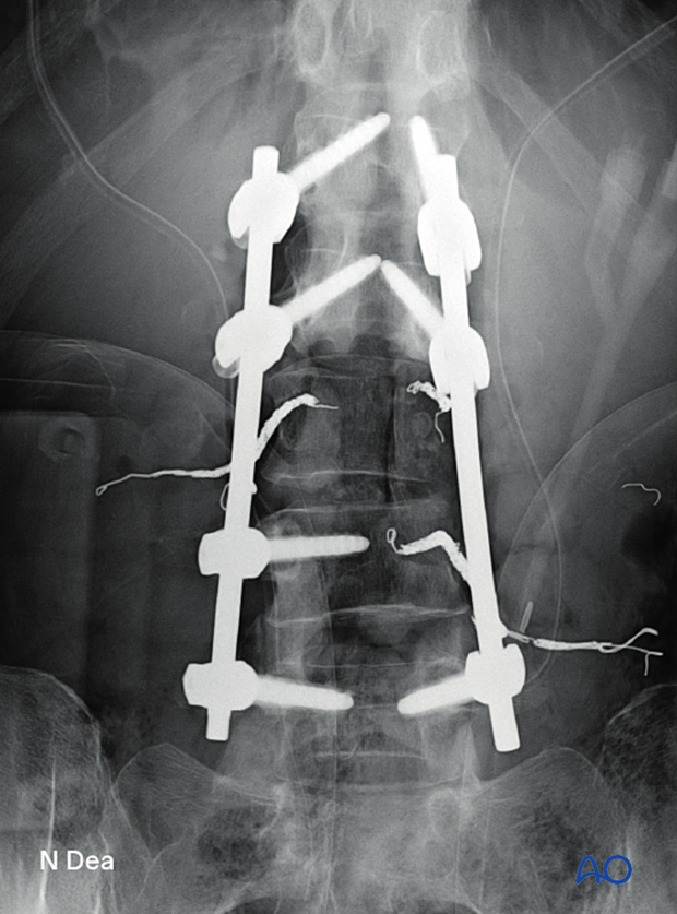 Intraoperative AP image after en bloc resection of posterior lumbar tumor showing position of screws and rods