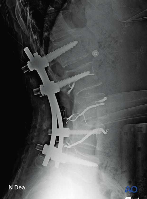 Intraoperative lateral image after en bloc resection of posterior lumbar tumor showing position of screws and rods