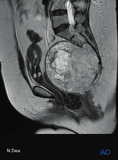 En bloc resection (S1 to S2) for Malignant sacral tumors