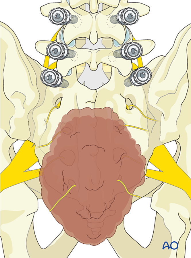 Sacrectomy Video En bloc resection (S1 to S2) for Malignant sacral tumors