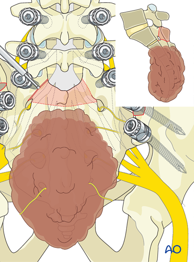 Sacral laminectomy during en bloc resection S1 to S2