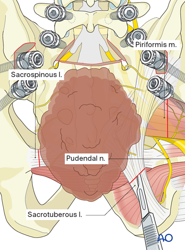 Soft-tissue dissection during en bloc resection S1 to S2