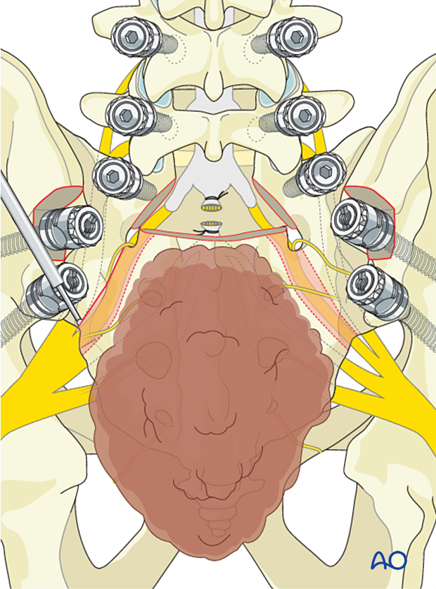 Removal of bone during en bloc resection S1 to S2