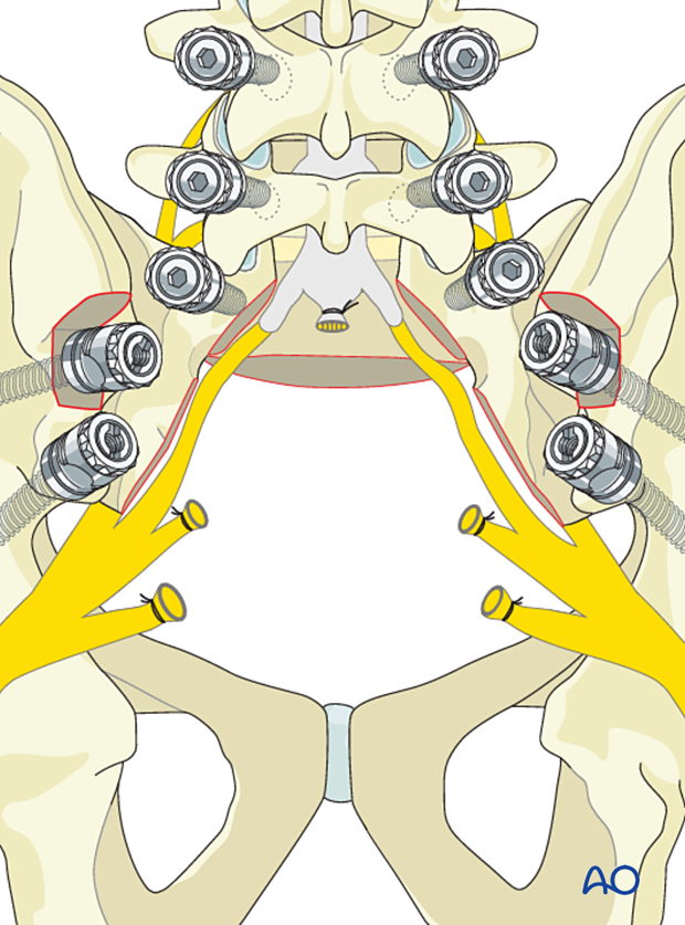 Tumor delivery during en bloc resection S1 to S2