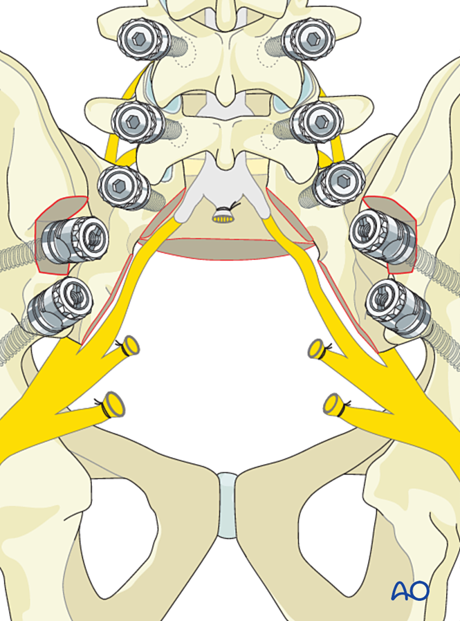 En bloc resection (S1 to S2) for Malignant sacral tumors