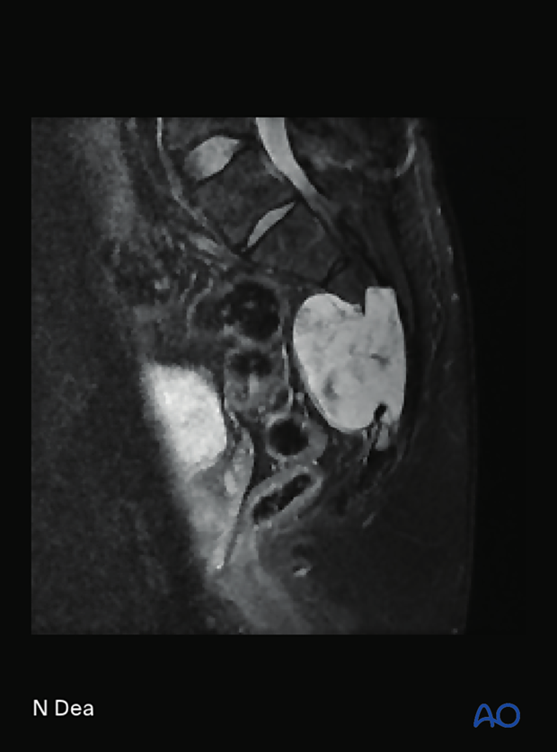 Image of S3 to S5 chordoma