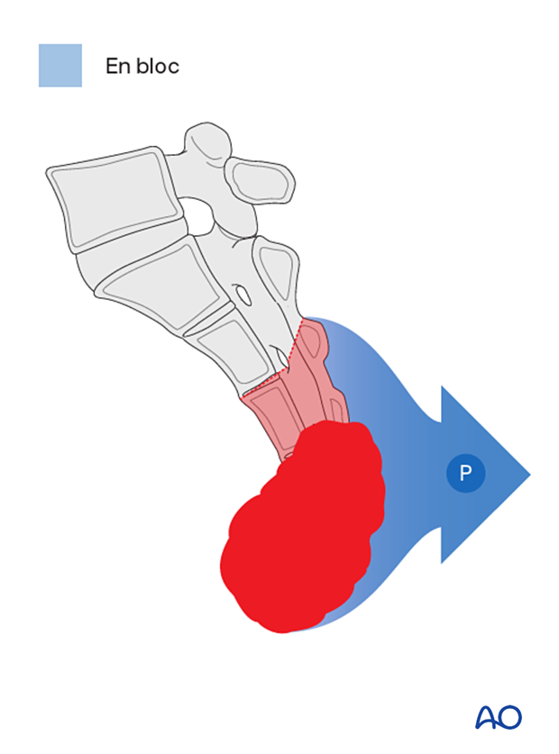 Strategy for en bloc resection S3 to S5