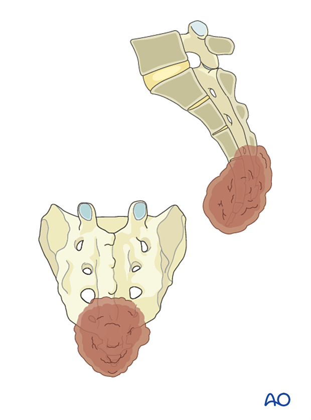 A low sacral tumor located in S4–S5