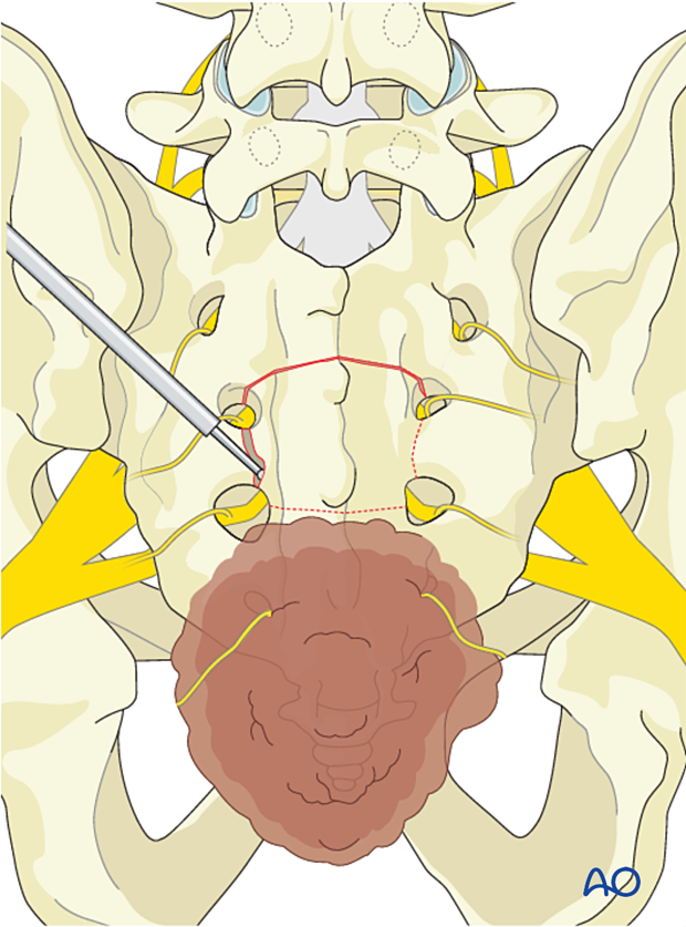 Progression of dissection from normal to abnormal tissues during en bloc resection S3 to S5