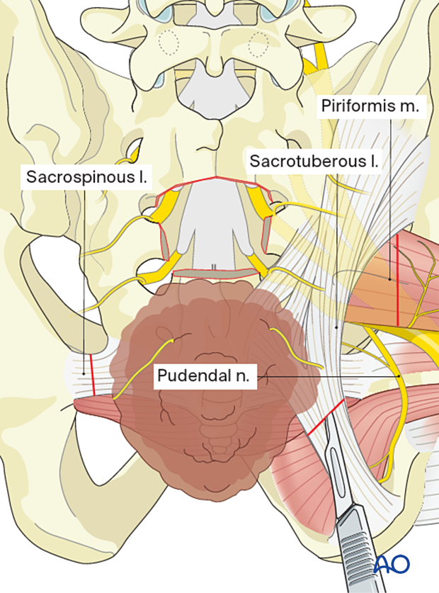 Soft tissue dissection during en bloc resection S3 to S5