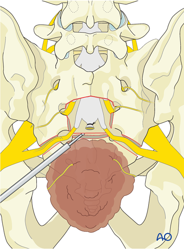 transverse osteotomy during en bloc resection S3 to S5