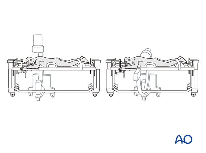 Prone position for approaches to T1–S5