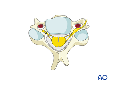 Ligation of nerves