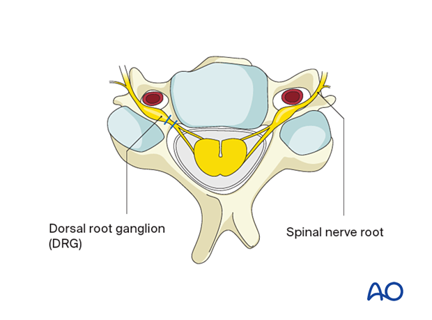 To decrease the risk of neuropathic pain, the nerve should be ligated proximal to the dorsal root ganglion