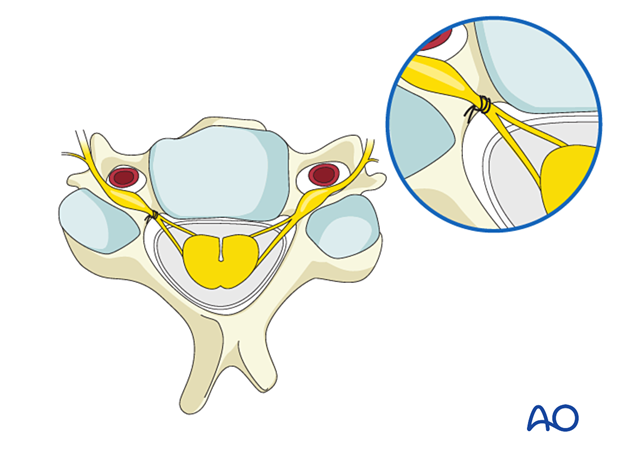 A suture is passed around the spinal nerve proximal to the DRG and as close to the dural takeoff as possible. It is then tied.