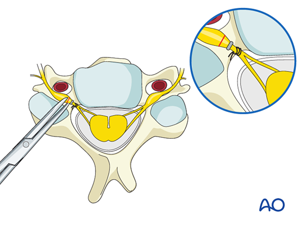 The nerve distal to the suture or the hemoclip is cut