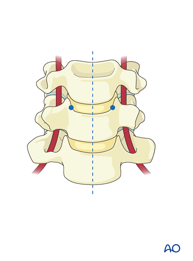 Before performing a cervical discectomy, the midline and uncovertebral process are identified