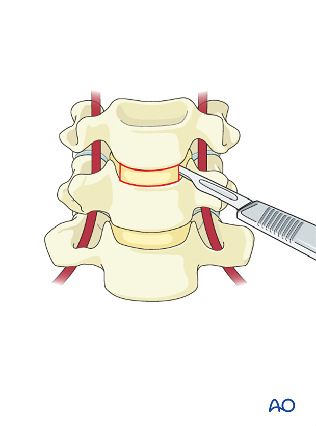 A small blade is used to open the annulus from uncinate to uncinate during a cervical discectomy