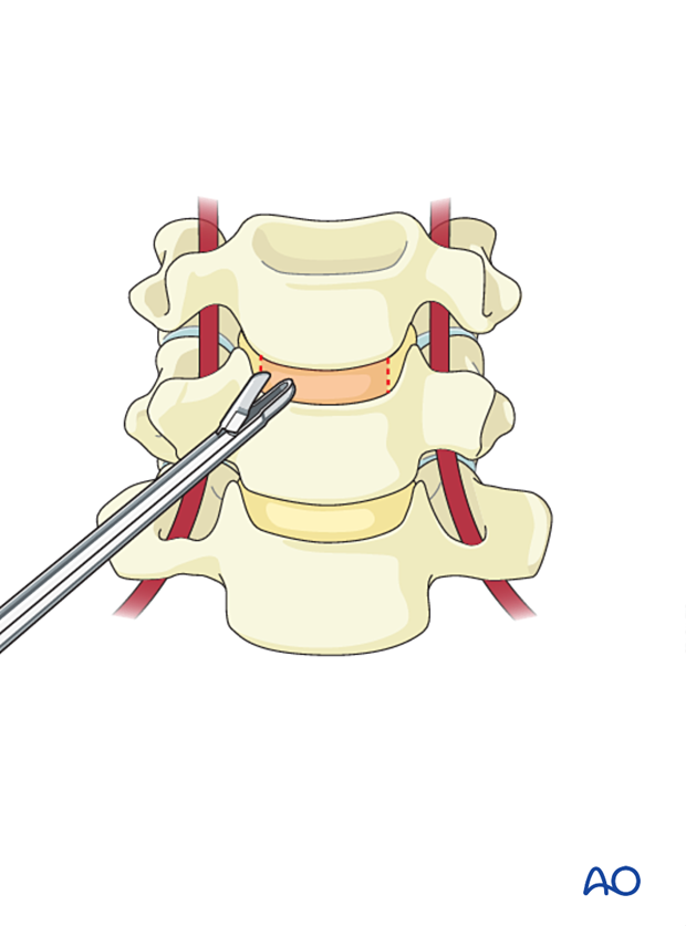 Pituitary rongeur forceps are used to remove the annulus during a cervical discectomy