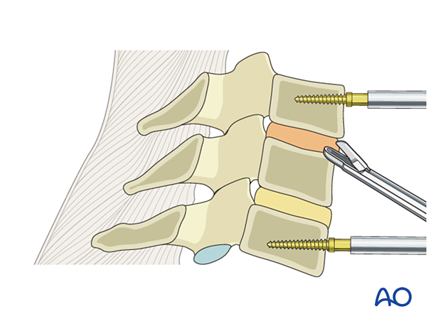 Cervical discectomy