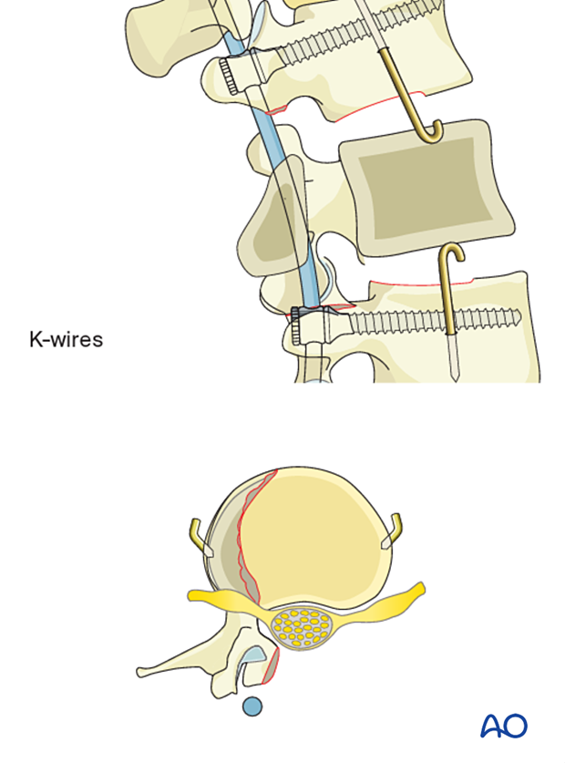 Using K-wires inserted in the vertebral body above and below to provide support for the PMMA during vertebral body reconstruction.