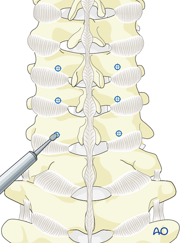 Opening the cortex during lateral mass screw insertion magerl technique