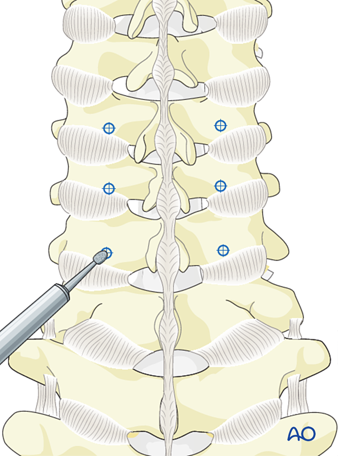 Lateral Mass Screw Insertion Magerl Technique