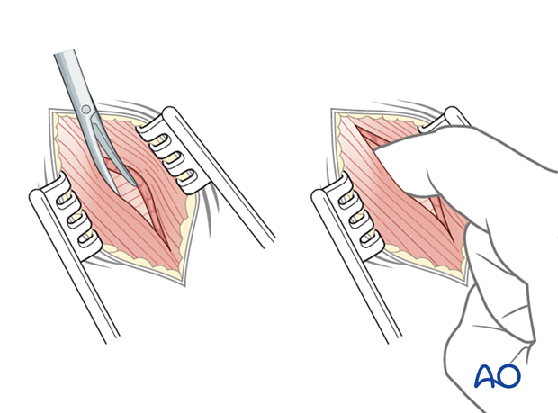 Splitting the external abdominal oblique muscle during a minimally invasive transpsoas approach